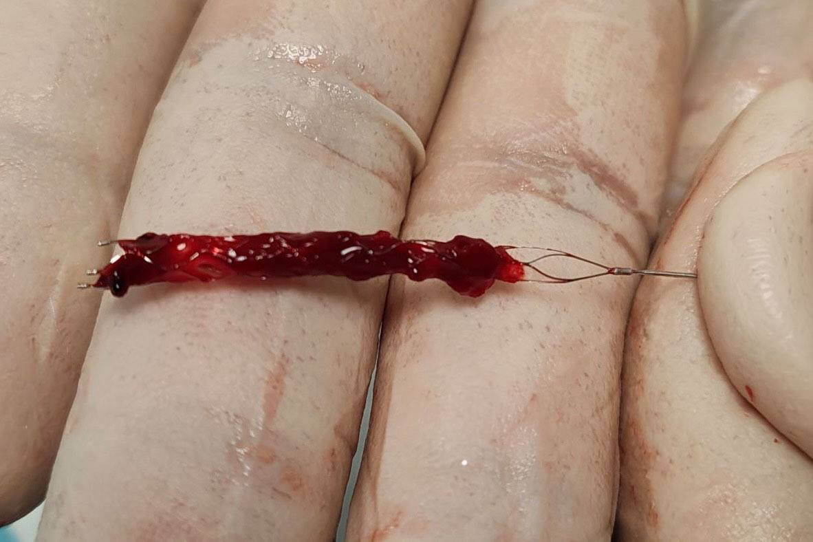 Тюменские врачи извлекли тромб из сонной артерии пациента