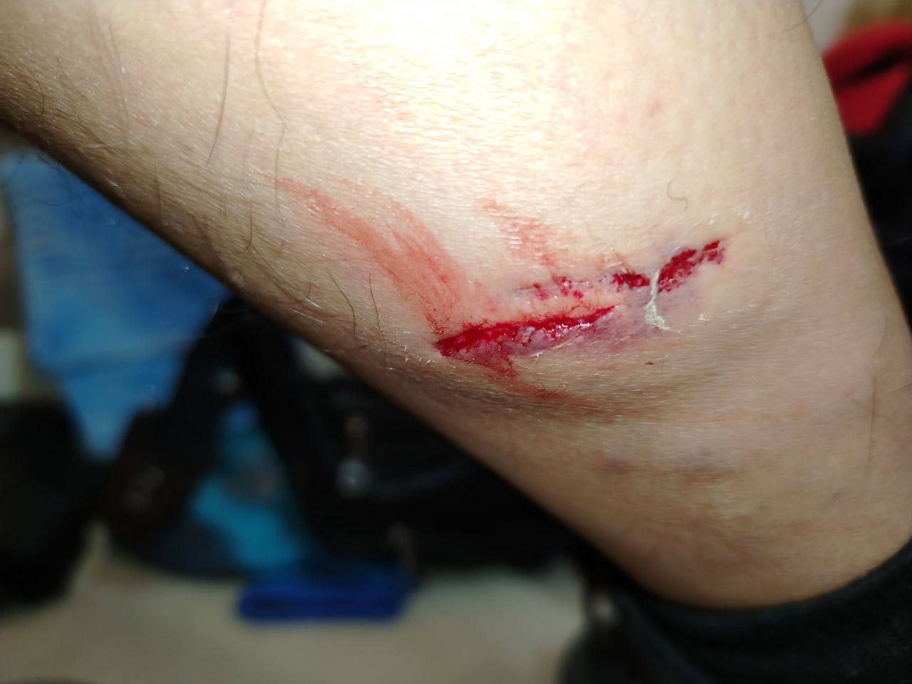 Собаки напали на тюменца на Муравленко — раны до крови Собаки напали на тюменца на Муравленко — раны до крови