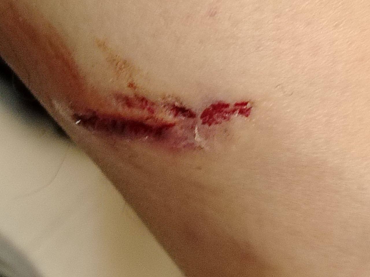 Собаки напали на тюменца на Муравленко — раны до крови Собаки напали на тюменца на Муравленко — раны до крови