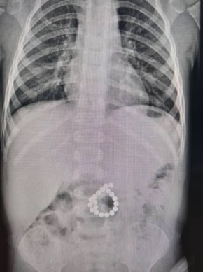 На севере региона спасли малыша с десятками магнитов в животе