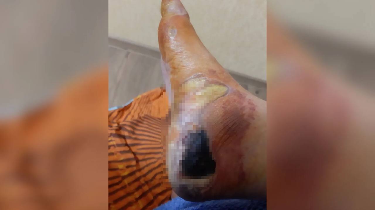 В Тюмени еще одна пациентка ОКБ №2 обожглась об батарею и получила некроз тканей