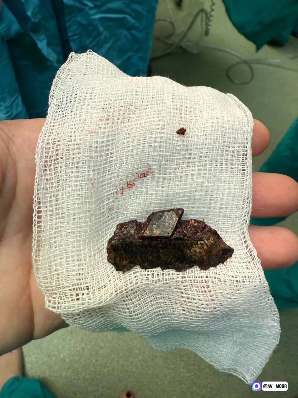 Тюменские хирурги достали из тела мужчины осколок, с которым он жил больше двух лет Тюменские хирурги достали из тела мужчины осколок, с которым он жил больше двух лет