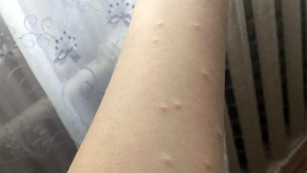В России растёт число случаев «зуда купальщика»: этим летом церкариоз выявили не менее чем в восьми регионах страны